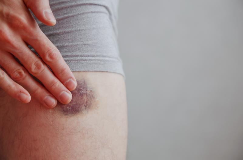 Jak rychle zmizí modřina? Urychlete hojení těmito jednoduchými kroky