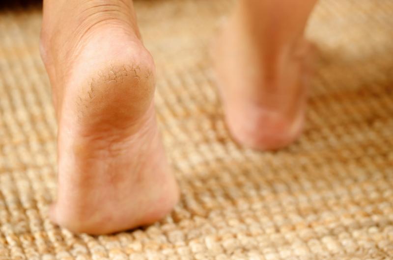 Tajná koupel, po které mizí popraskané paty: Dermatologové potvrzují, že funguje