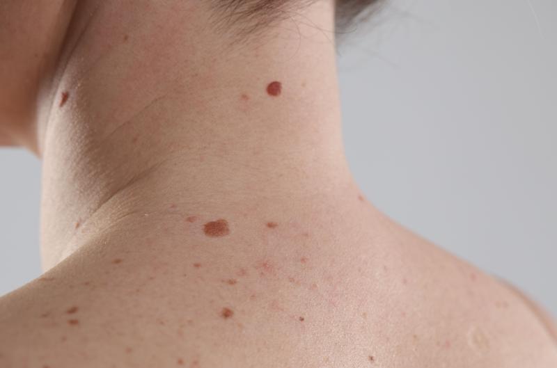 Jak se zbavit jaterních skvrn: Co opravdu funguje a čemu se raději vyhnout?