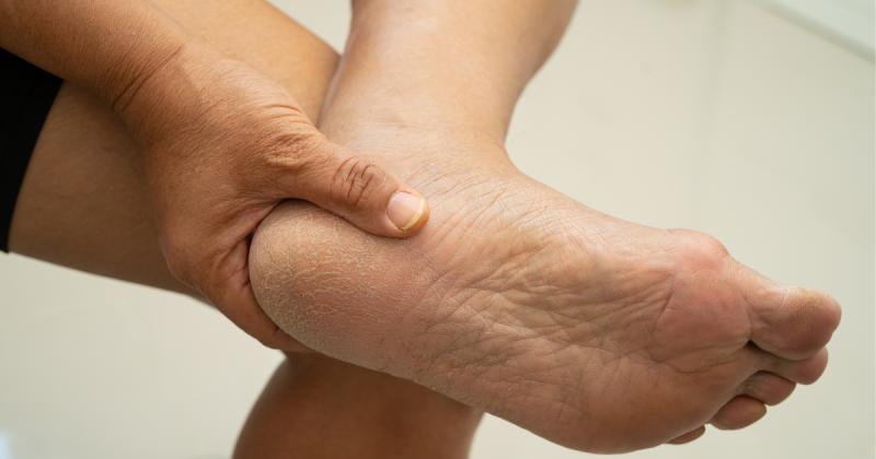 Popraskané a suché paty mizí rychleji, než čekáte. Tento domácí trik překvapil i odborníky