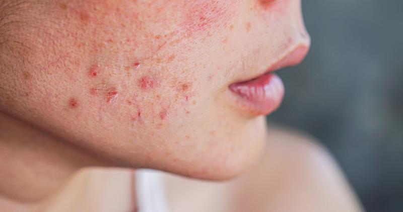 Melasma nebo stařecké skvrny? Tento detail na pleti prozradí rozdíl